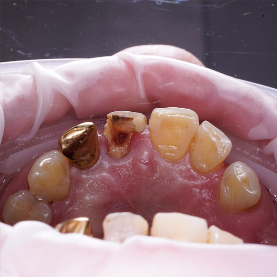 Имплантация зуба за час в Екатеринбурге
